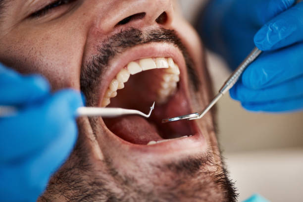 Best Knocked-Out Tooth (Avulsed Tooth) Treatment in Lavallette, NJ